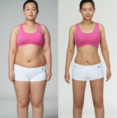 25-34 year old woman treated with Liposuction - Whole Body liposuction before and after