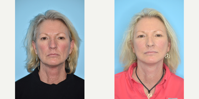55-64 year old woman treated with Deep Plane Facelift, Facelift, Neck Lift, Mini Neck Lift - This 60 year old female is one month out from her deep plane facelift and neck lift and is thrilled with the improvement in her neck laxity and jawline.