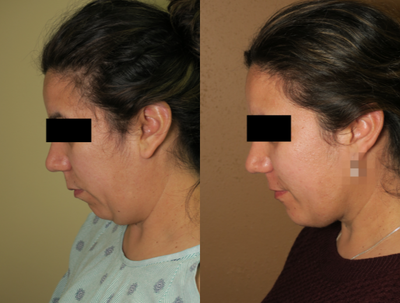 25-34 year old woman treated with Chin Implant - chin augmentation and lipo of the neck with J Plasma