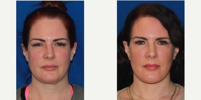 35-44 year old woman treated with SMAS Facelift, Neck Lift - 35-44 year old woman treated with SMAS Facelift, Neck Lift