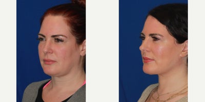 35-44 year old woman treated with SMAS Facelift, Neck Lift - 35-44 year old woman treated with SMAS Facelift, Neck Lift