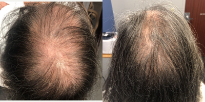 55-64 year old woman treated with Low-Level Laser Therapy - 4 PRP Hair Restoration Treatments, 3 PepFactor Hair Restoration Treatments with microneedling, combined with Low Level-Laser Therapy
