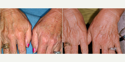 65-74 year old woman treated with SmartXide DOT fractionated CO2 laser for hand rejuvenation - This woman complained of fine lines, sun damage and brown spots on her hands that made her look older than she wanted.  Single treatment with the DOT CO2 laser at fractionated settings made her hands appear more youthful and less sun damaged.