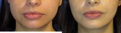 30 year old woman treated with Chin Implant - This 30 year old female desired more definition of her chin. She had chin augmentation with a Medium silicone chin implant and neck liposuction under local anesthesia and oral sedation. Note the enhanced chin projection and elevated neck contour.