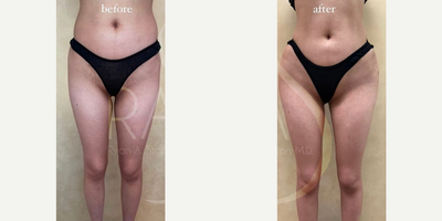 Woman treated with Hip Augmentation - Woman treated with Hip Augmentation