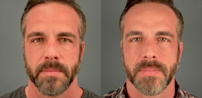 45-54 year old man treated with Venus Viva - Venus Viva fractional radiofrequency/RF treatment is fantastic for facial resurfacing (wrinkles, sun spots, crepe skin, fine lines, pore reduction, and texture improvements), scars, and melasma. Since it is not a laser it can be used on all skin types (including darker skin and sensitive skin like those with eczema and/or rosacea). It is also fantastic for acne, as it helps the topical medications used to treat acne to penetrate the skin more readily. Long term tightening and lifting is improved with Venus Viva in combination with other skin tightening procedures such as radiofrequency/RF like Venus Legacy or ultrasound like Ultherapy.