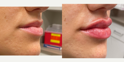 25-34 year old woman treated with Restylane Kysse - Restylane Kysse lip fillers with Dr. Wise at the Wise Center for Plastic Surgery in Wayne, NJ to create a plumped up and symmetrical look!