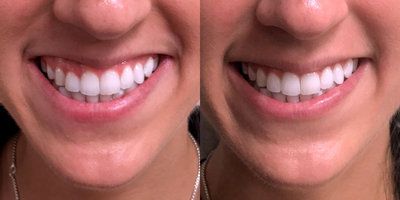 18-24 year old female treated with Botox for Gummy Smile - Neuromodulator injections to address gummy smile.