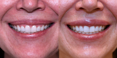 25-34 year old female treated with Botox for Gummy Smile - Neuromodulator injections to address gummy smile.