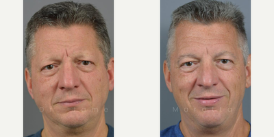 Eyebrow Transplant - Scalp isn't the only area of concern that can be treated with a Hair Restoration.