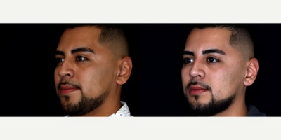 26 year old man treated with Nonsurgical Nose Job - 26 year old man treated with Nonsurgical Nose Job. Photos depict before and 1 month after 1 syringe of Restylane Lyft was injected to the nose (liquid rhinoplasty)