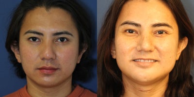 25-34 year old transgender woman treated with Buccal Fat Removal - Facial Gender Affirmation Surgery