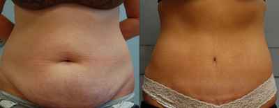 35-44 year old woman treated with Tummy Tuck - Pre op pant size: 12 / weight: 153lbsPost op pant size: 0/00 / weight: 101lbs
