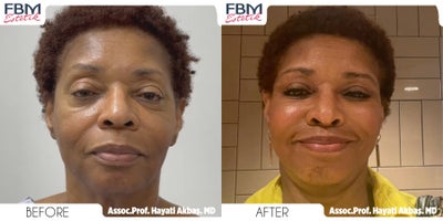 45-54 year old woman treated with Deep Plane Facelift, Neck Lift, Double Eyelid Surgery, Lip Lift - 45-54 year old woman treated with Deep Plane Facelift, Neck Lift, Double Eyelid Surgery, Lip Lift