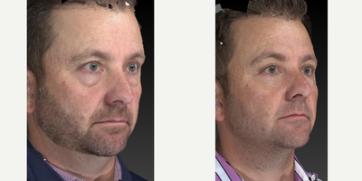 45-54 year old man treated with Eyelid Surgery - We are doing more and more cosmetic procedures on men. Everyone likes to look good!