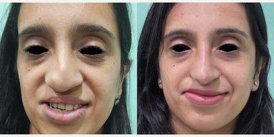 25-34 year old woman treated with Revision Rhinoplasty, Lip Surgery - 28. year old who had cleft lip revision surgery and revision rhinoplasty