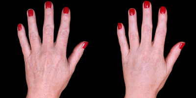 A 35-44 year old female treated with Hand Rejuvenation - Dr. Khorasani injected this patient with dermal fillers to restore youthfulness to hands.