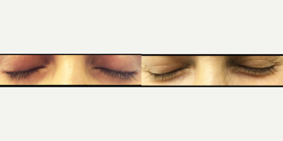Permanent Eyeliner Tattoo Removal - Completely resolved permanent eyeliner tattoo, post 3rd Picosure laser tattoo removal