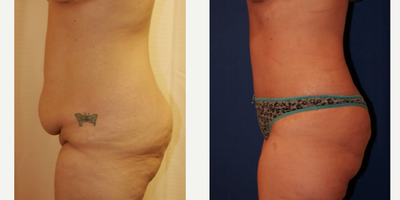 35-44 year old woman treated with Tummy Tuck - 39 year old female, mother of 3
Tummy Tuck