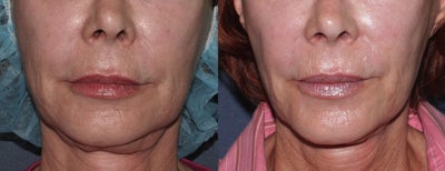 Ulthera Smile Lines | Before and After - 
	Patient underwent Ulthera therapy.
