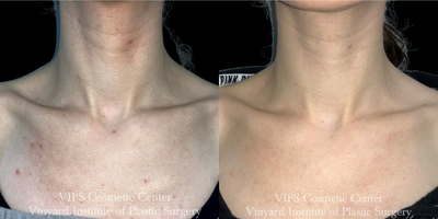 25-34 year old woman treated with CoolPeel, CO2 Laser - 25-34 year old patient treated with CO2 laser skin resurfacing CoolPeel to the chest to reduce fine lines, wrinkles, sun damage, pore size and improve overall skin brightness, texture and tone.