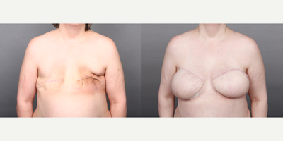 45-54 year old woman treated with Breast Reconstruction with Bilateral DIEP Flaps - 45-54 year old woman treated with history of Left Breast Cancer, Bilateral Mastectomy, left chest radiation, and Breast Reconstruction with Bilateral DIEP Flaps