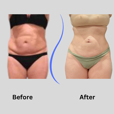 53 year old woman treated with Funsculpting HD Lipo to Abs & Flanks - Funsculpting Hd lipo abs and flanks procedure.