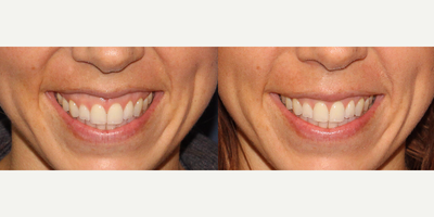25-34 year old woman treated with Botox - Before and after of a young woman treated with Botox for a gummy smile.