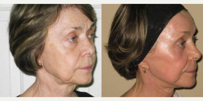 Woman treated with Laser Resurfacing - Laser Skin Resurfacing