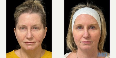 35-44 year old woman treated with NeoGen Plasma, Skin Rejuvenation - NeoGen is a game changer for the skin rejuvenation game, and this lovely patient is a perfect example of Skin MD protocols and expertise providing excellent results!