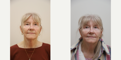 55-64 year old woman treated with TCA Peel, Facial Fat Transfer - 35% TCA & 10% Phenol peel with fat grafting to face