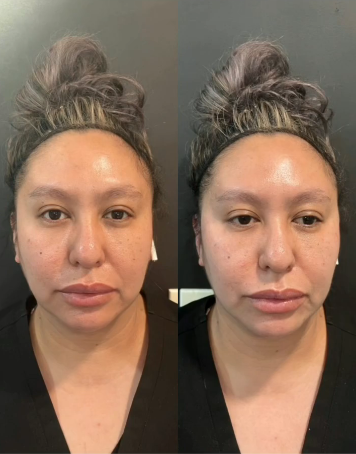 Woman treated with Cheek Lift - Woman treated with Cheek Lift