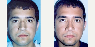 Man treated with Rhinoplasty - Man treated with Rhinoplasty through straightening of his nose and smoothening of his nose'stip.