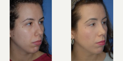 Woman treated with Rhinoplasty - Woman treated with Rhinoplasty through reshaping of hernasal tip and bridge.