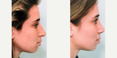 Woman treated with Rhinoplasty - Woman treated with Rhinoplasty