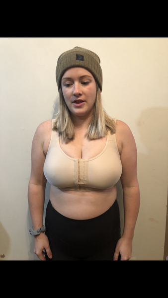 28 year old breast reduction - couldn't be happier! 34F to 34C - R