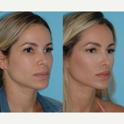 25-34 year old woman treated with Lip Lift - 27 year old 6 months after lip lift