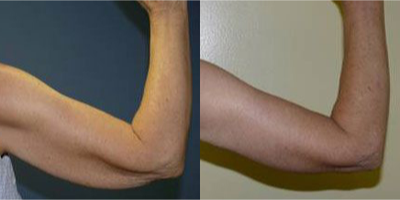 55-64 year old woman treated with Arm Lift - brachioplasty