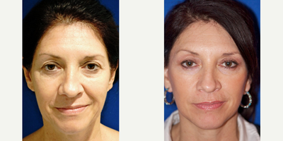 45-54 year old woman treated with Upper Facelift - 51 year old female
