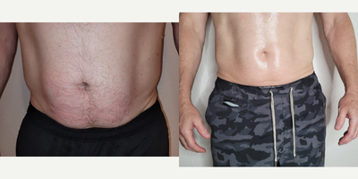 45-54 year old man treated with Cryoskin, Cryolipolysis - Amazing result post 2 Cryo T Shock Sessions and 2 Cryo Drainage Massage. It is important to note that you must work out for 40 minutes after each session to gain maximum results. The Cryo T Shock is a non-invasive solution to rid the body of fat cells. Patient opted for Laser hair removal