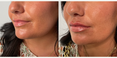 18-24 year old woman treated with Lip Fillers, Juvederm, Vollure - Patient treated with one syringe of Juvederm Vollure for lip augmentation