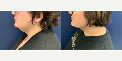 35-44 year old woman treated with Liposuction, Renuvion, AlloDerm - This 41-year-old patient underwent liposuction with Renuvion of the anterior neck by Dr. Patterson at Gulf Coast Plastic Surgery. Just 6 weeks post-op, you can already see the tightening and definition! Renuvion uses advanced plasma technology to contract and firm the skin, making it a great option for refining the jawline and neck.