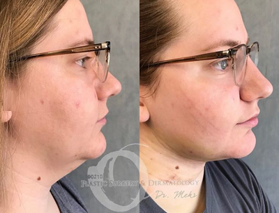 Woman treated with Liposuction - Woman treated with Liposuction