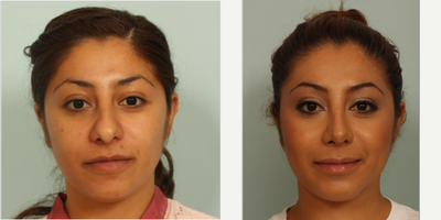 25-34 year old woman treated with Rhinoplasty - Primary Rhinoplasty with Chin Augmentation
