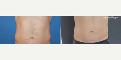 Woman treated with CoolSculpting - Woman treated with CoolSculpting