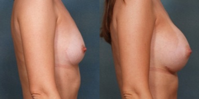 35-44 year old woman treated with Breast Augmentation - Age: 35
Height: 5'3
Weight: 115 lbs.
Implant Type: Natrelle Silicone Moderate Plus Profile
Implant Size: 339 cc
This woman wanted to increase her size from a small A to a full C cup. Dr. Bucky utilized style 15 339cc moderate profile silicone gel breast implants in a submuscular position.