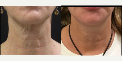 55-64 year old woman treated with Secret RF to neck - 55-64 year old woman treated with Secret RF to neck