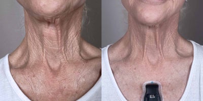 75 year old woman treated with YAG Laser - This 75-year-old patient underwent a series of six Erbium laser treatments to rejuvenate her neck area. In the before image, you can see visible signs of aging, including fine lines and loose skin. The after image shows a remarkable transformation, with her neck appearing smoother, firmer, and more youthful. The Erbium laser effectively minimized lines and enhanced skin texture, offering a non-surgical approach to neck rejuvenation for a naturally refreshed look.
