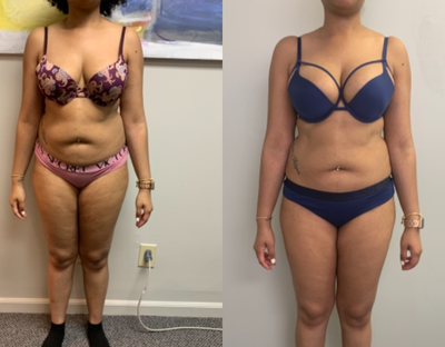 25-34 year old woman treated with Zerona - This client completed 6 Zerona treatments and lost a total of 4.5 inches from her midsection, 3.5 inches from her thighs, and 2.5 inches from her arms.