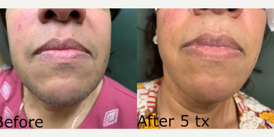 Woman treated with Laser Hair Removal - Woman treated with Laser Hair Removal